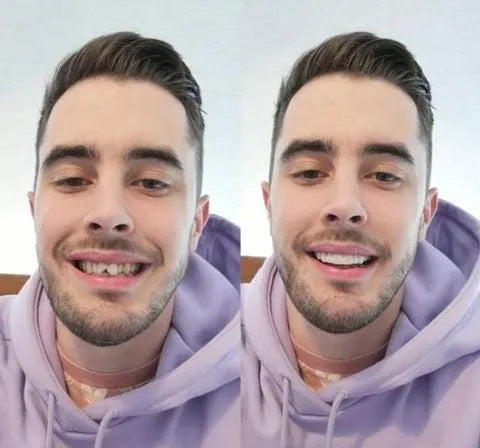 Sofort wirkende Veneers-Zahnblende - Mit Ober- und Unterkieferteil