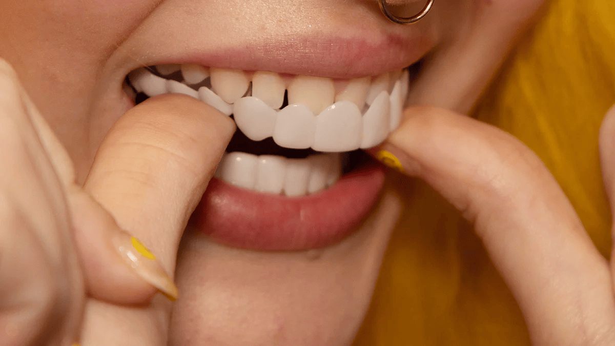 Snap-on Veneers – Sofortige Lächelnkorrektur gegen ästhetische Makel