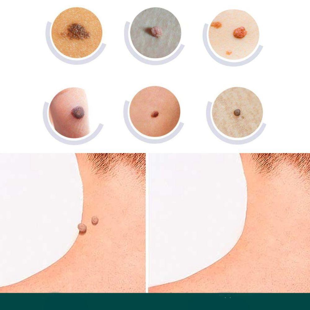 SkinClear Pflaster zur Entfernung von Hautanhängseln und Warzen | Hydrokolloid-Technologie | Schmerzfrei und diskret | Für alle Hauttypen | 120 Stück